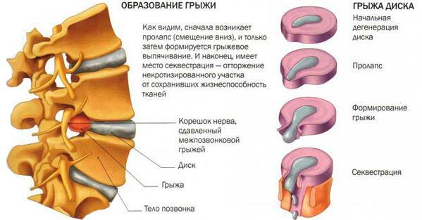 Educación de la hernia
