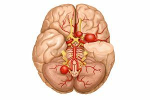 Uzroci, simptomi i liječenje cerebralnog vazospazma