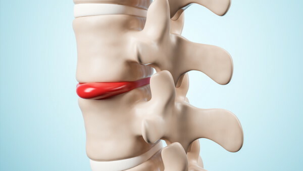 Herniated disc: symptoms and signs, how to identify