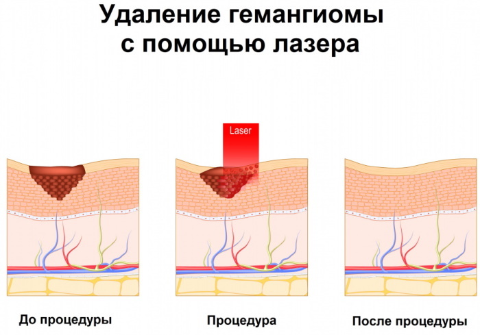 Deride hemanjiyom. Fotoğraf, ultrason, açıklama