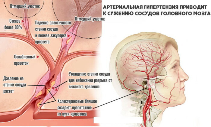 Boyun damar stenozu. Belirtileri ve tedavisi nedir