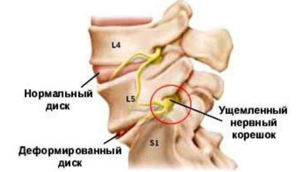 Semne de osteochondroză a coloanei vertebrale cervicale - o descriere detaliată!