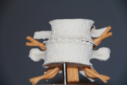 Stage 4 - degenerative recovery of the spine