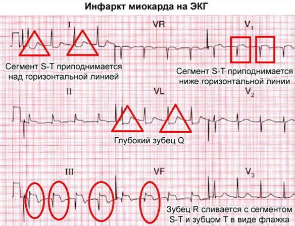 Miokarda infarkts: ko darīt, pirmā palīdzība