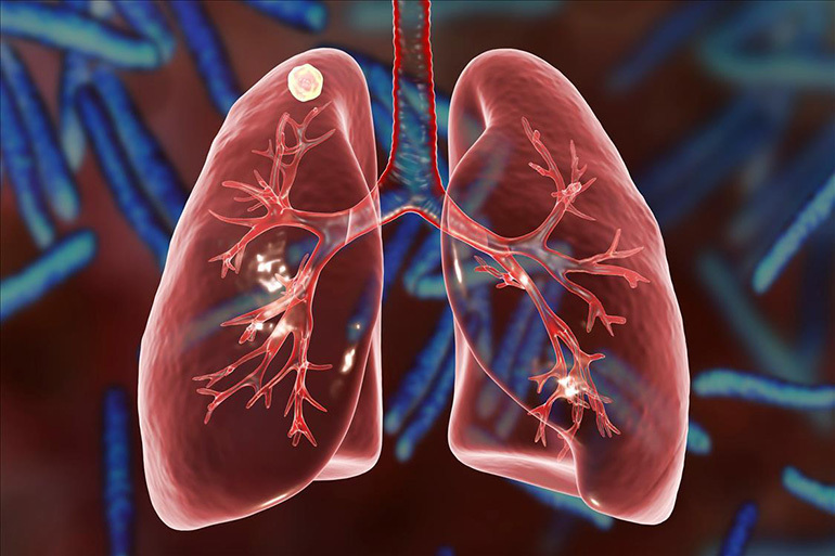 Focal pulmonary tuberculosis: general characteristics