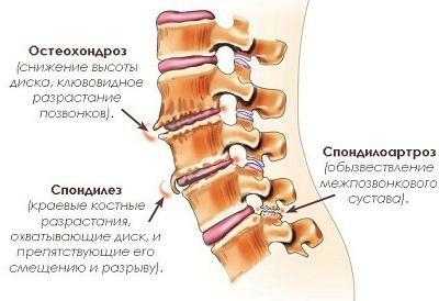Osteocondrosis de la columna lumbosacra: síntomas