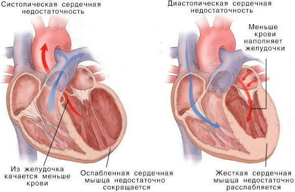 Insuficiență ventriculară stângă acută. Care sunt acestea, simptome, motive