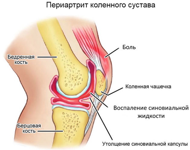 Periartrite da articulação do joelho. Sintomas e tratamento de tendões