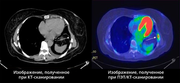 Diet before PET-CT examination with fluorodeoxyglucose, contrast agent, choline