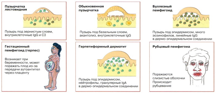 Pemphigus vulgaris: diferentsiaaldiagnostika, kliinilised juhised