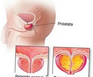 Prostatitis y diferencias en prostatitis.