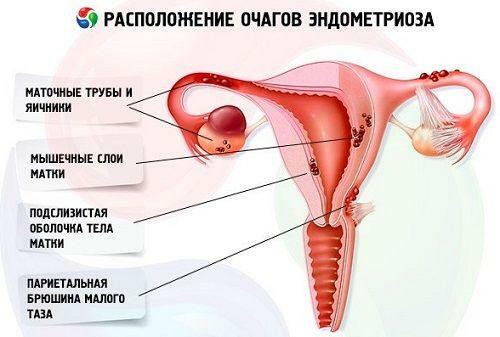 Location of foci of endometriosis