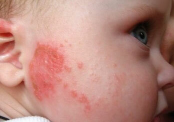 ¿Cómo se ve la alergia en los niños?