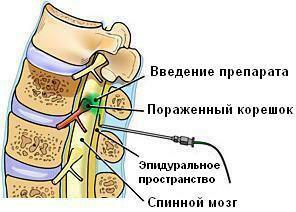 Bloqueo de la columna vertebral