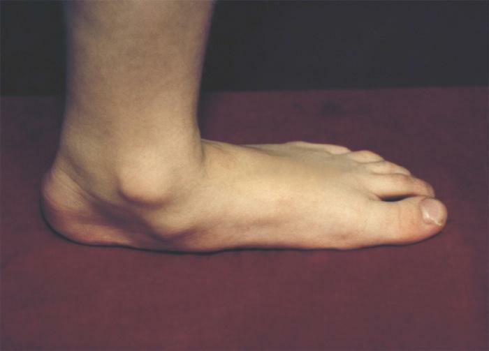 Flat footedness - fotografie