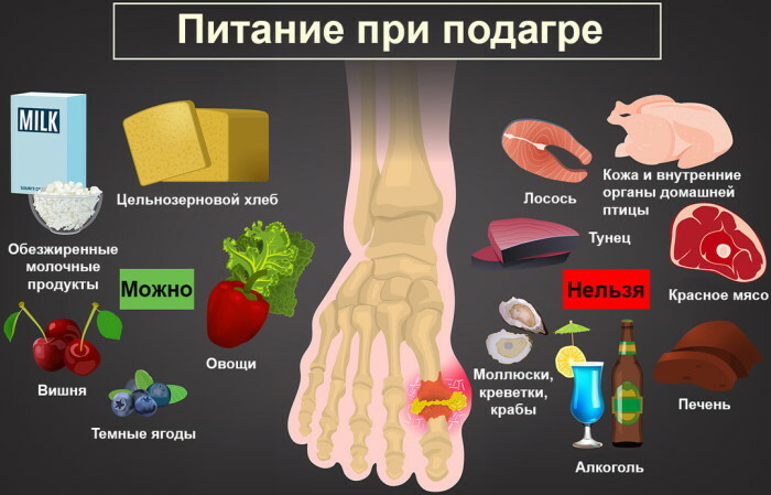 Gout on the legs. Photo, treatment, pills, alternative methods
