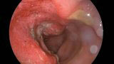 El cáncer de intestino y su diagnóstico