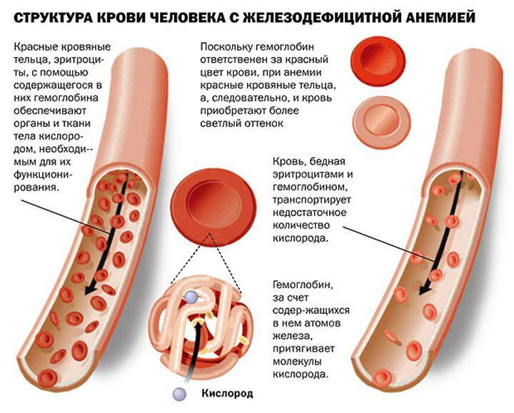 Structure of blood in iron deficiency anemia