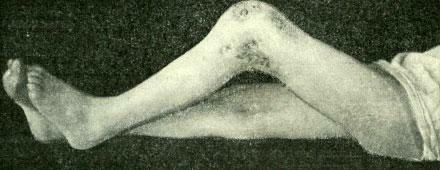 Fistula with tuberculosis of the knee joint