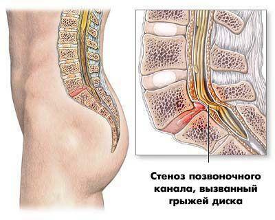 Stenoza spinării cauzată de hernia discului