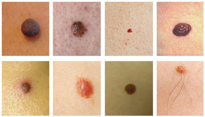 Types of moles on the body, face. Photos with a description, dangerous or not