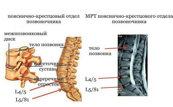 RMN-ul coloanei vertebrale lombosacrale