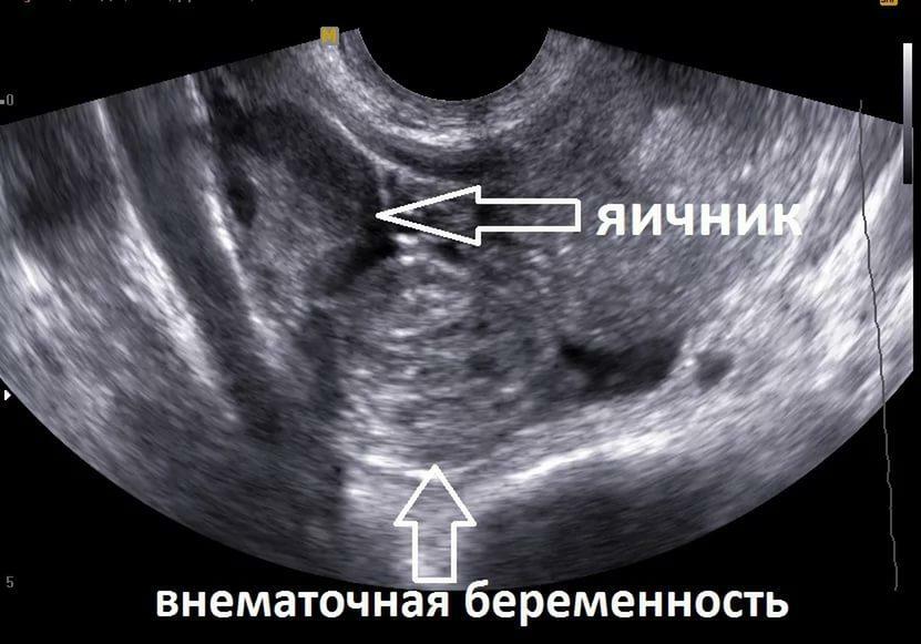 Simptomele sarcinii ectopice în primele zile - informații detaliate