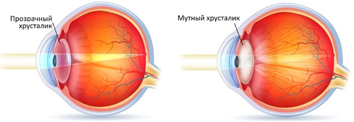 Globul ocular. Crește de la naștere de-a lungul vieții, structurii, anatomiei