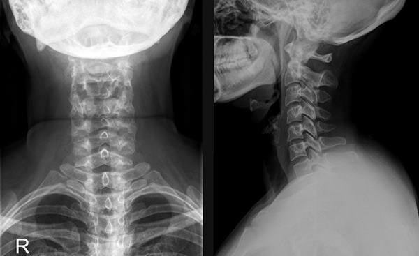 Yedinci servikal vertebra. nerede, fotoğraf, anatomi