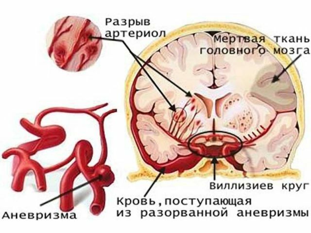 Hva er aneurysmen i hjernebruskene og hva er konsekvensene av brudddet
