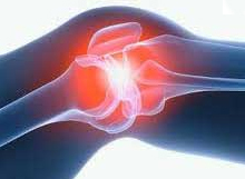 Líquido en la articulación de la rodilla( sinovitis): tratamiento, causas, síntomas, remedios caseros
