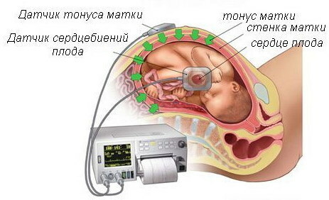 Hamilelik 1-2-3 trimesterde uterusun hipertonisitesi. Tedavi