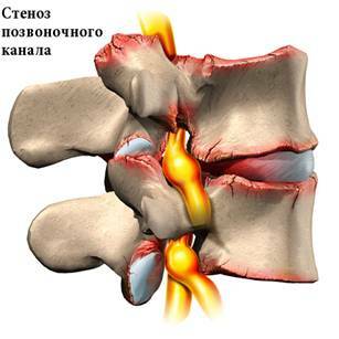 Estenosis del canal espinal en el esquema