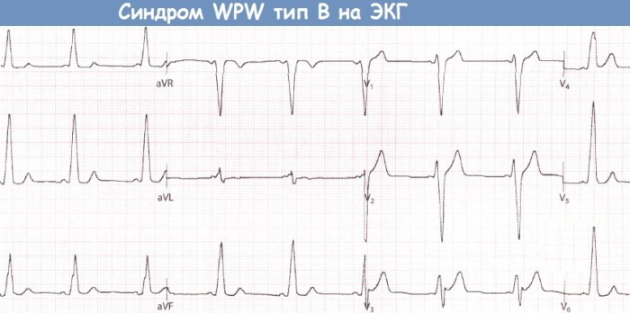 WPW (WPW) EKG sindroms. Pazīmes, ka tā ir