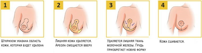 Sânii încordați: cum să strângeți, să preveniți sânii lăsați la femei