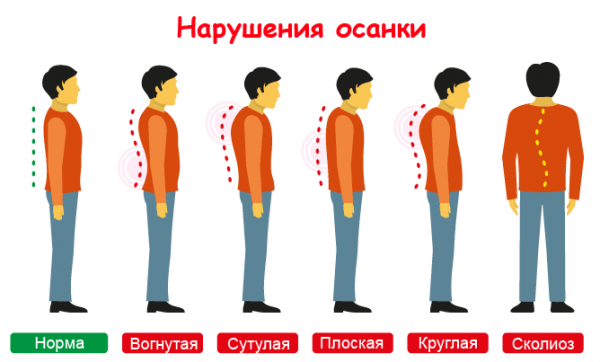 Types of violations of posture