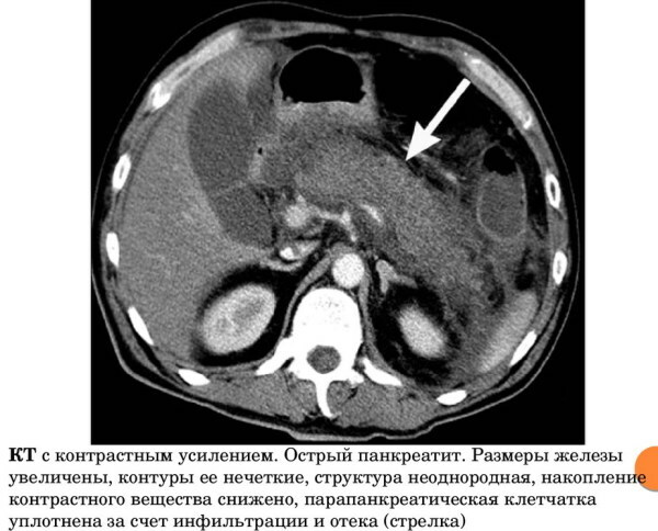 Tecken på inflammation i bukspottkörteln hos en kvinna