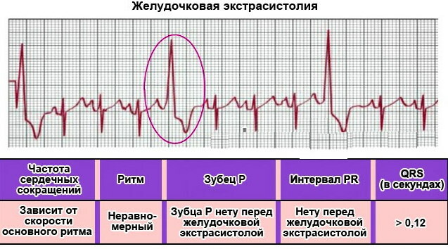Ventrikulárny extrasystol na EKG: znaky, dekódovanie