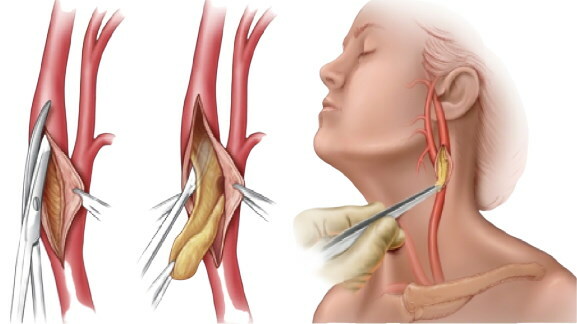 Nestenotična ateroskleroza BCA (brahiocefalnih arterija)