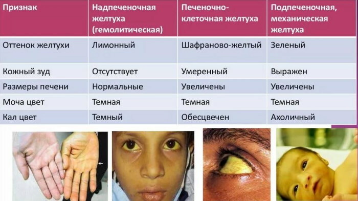 Jaundice in adults. Causes, symptoms, treatment, consequences