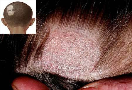 İnsanlarda saçak hastalığı - tedavi, semptomlar( fotoğraf), başlangıç ​​evresi