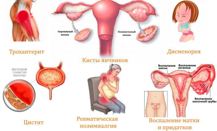 A hát alsó része a nőknél a bal hátsó részen fáj, a lábnak adja