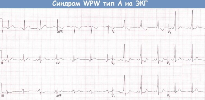 WPW (WPW) EKG sindroms. Pazīmes, ka tā ir