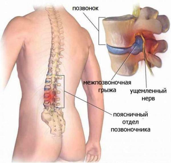 Intervertebral lomber herni