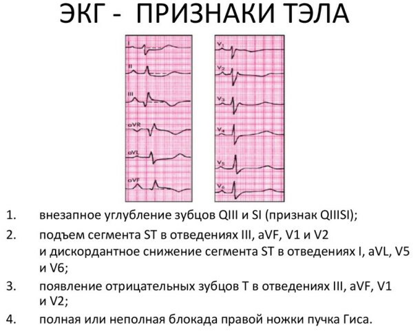 PE na EKG-u. Znakovi, fotografije, što je to, liječenje