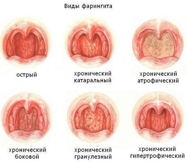 Types of pharyngitis