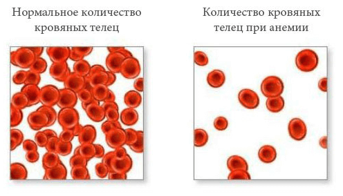 Numărul de celule sanguine în anemie