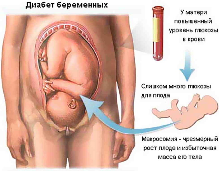 Suurenenud vere glükoosisisaldus raseduse ajal